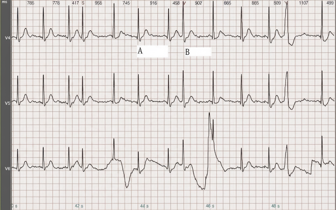 Current Research on ECG Classification Methods