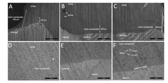 Microscopic Inspection of the Adhesive Interface of Composite Onlays after Cementation on Low Loading